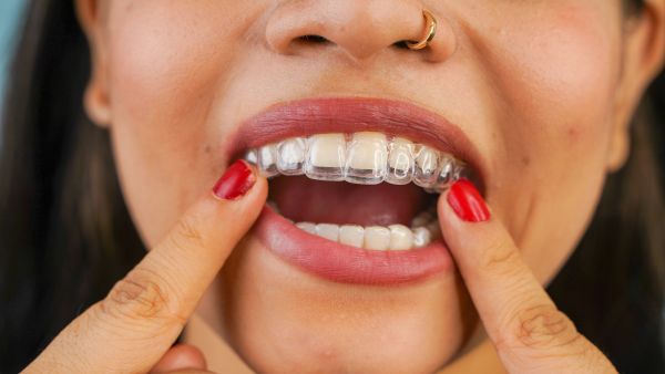 How Often Do You Really Need To Wear Invisalign Aligners?